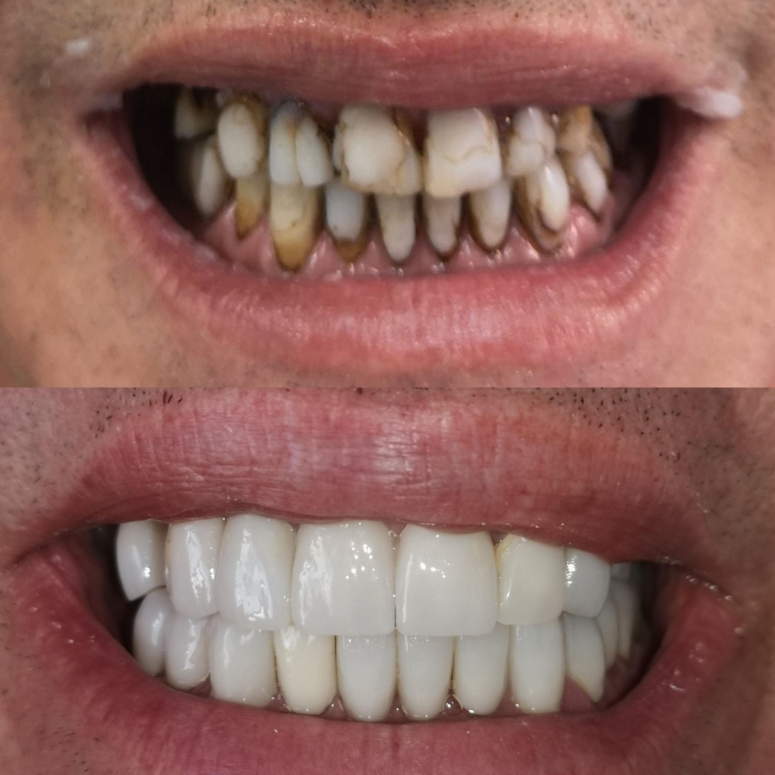 Restauración completa con zirconio - antes y después