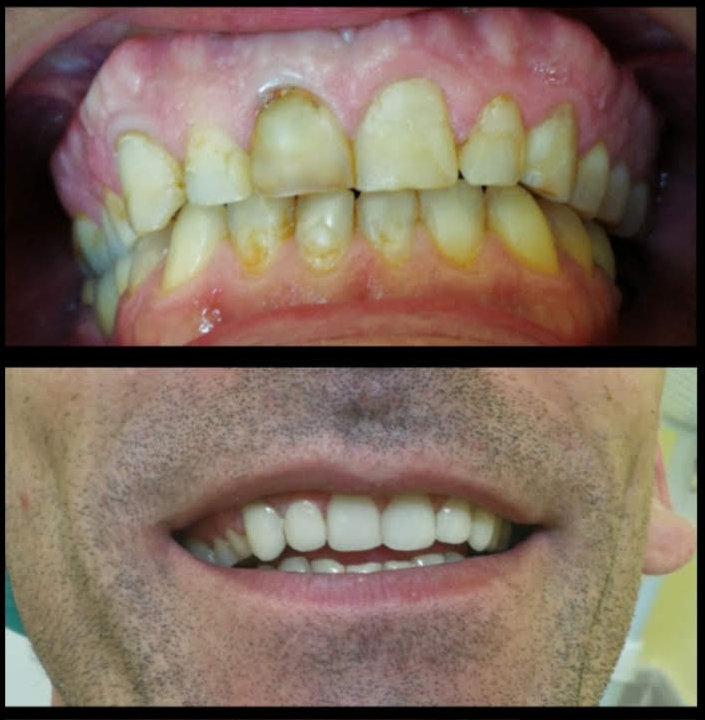 Diseño de sonrisa - antes y después