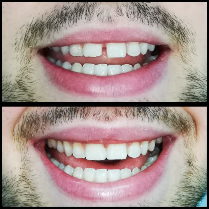 Reconstrucción estética de diastema - antes y después