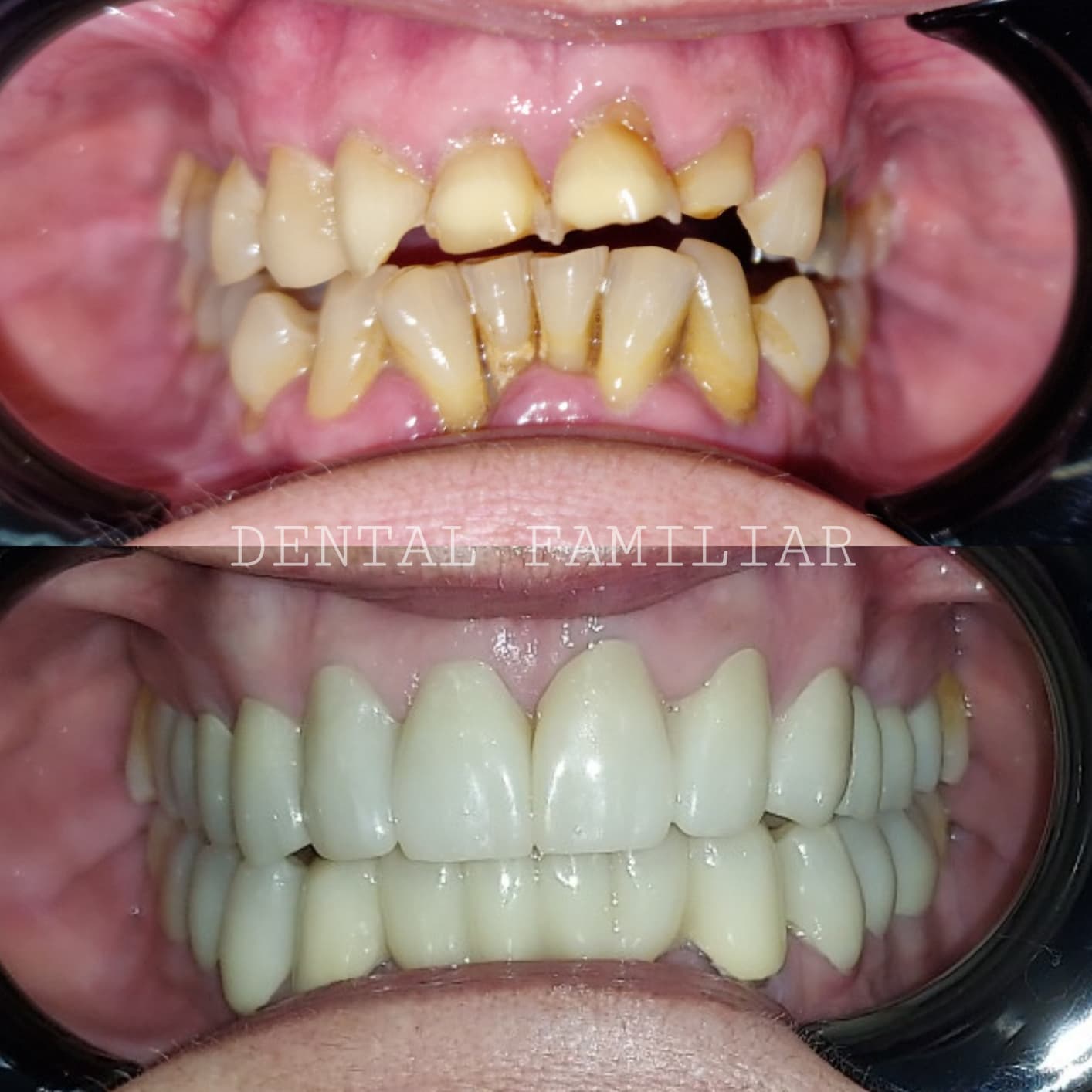 Rehabilitación completa con fundas de zirconio - antes y después