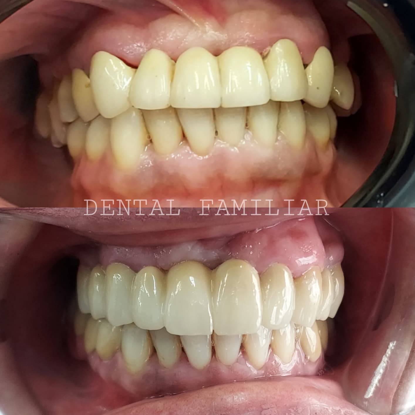 Rehabilitación con puente de zirconio - antes y después