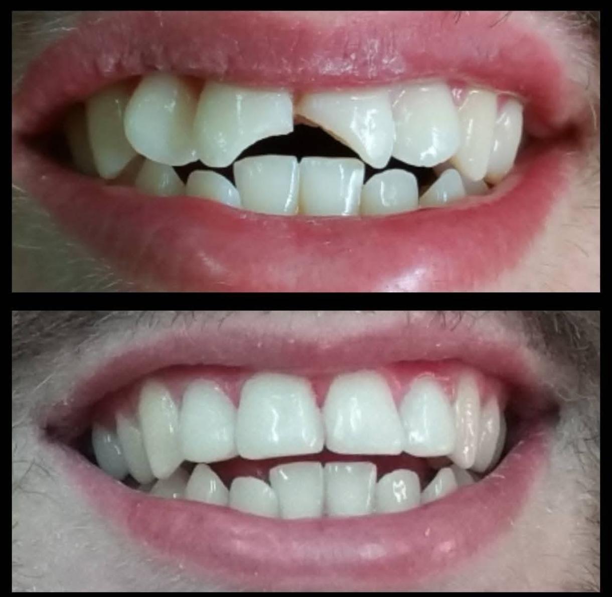 Fractura dental por caída - antes y después